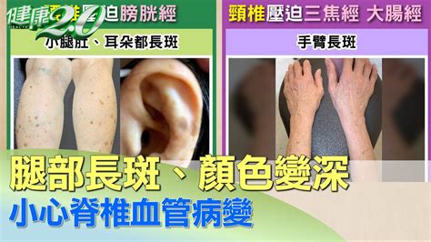 腳背長斑